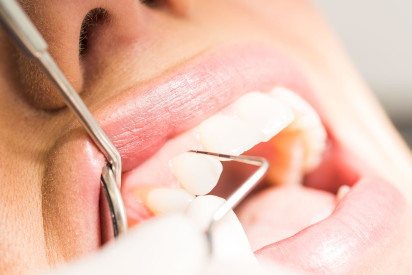 Mit einem PSI -Test misst der Zahnarzt die Tiefe der Taschen. Das ist der Bereich zwischen Zähnen und Zahnfleisch. Das Zahnfleisch entzündet sich schleichend und bleibt auch in diesem Zustand lange schmerzfrei.