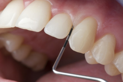 Taschentiefemessung - Zur Feststellung wie weit das Zahnfleisch mit dem Zahn verbunden ist.