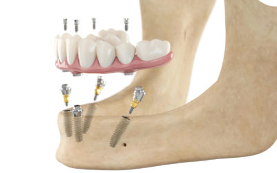 All on 4 Methode – Implantate für ein dauerhaftes Lächeln